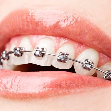 Clínica Dental Pérez - De Marziani ortodoncia